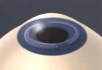 Oční klinika NeoVize, léčba keratokonu, intrastromální prstence keraring